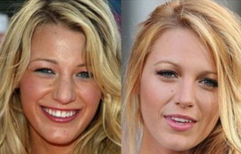 Блейк Лайвли, нынешняя подружка Леонардо Ди Каприо, исправила свой нос и вставила в грудь импланты