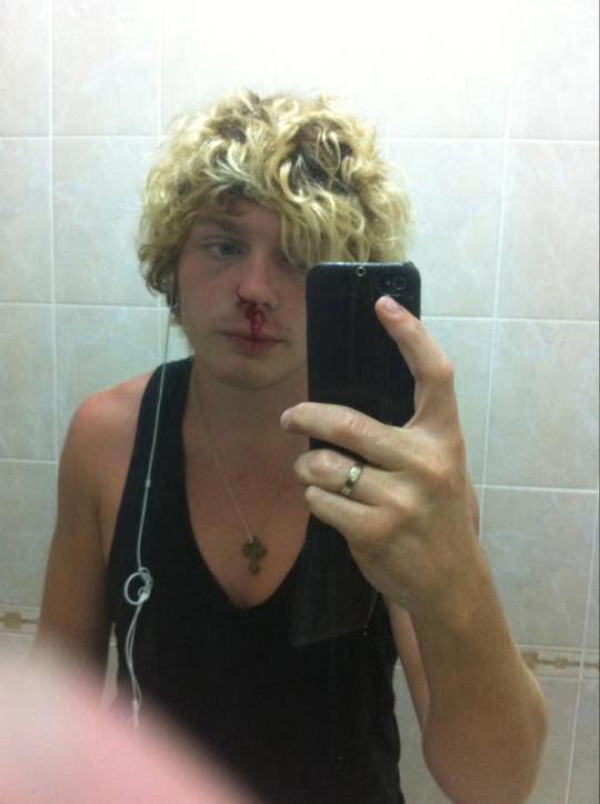 Денисова разбила Кривошапко нос!