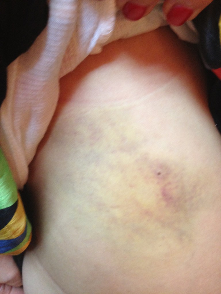 Лера Кудрявцева опубликовала фото украинки в кровоподтеках! Кто она?