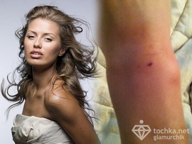 Викторию Боню покалечило животное