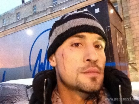 Лицо Димы Билана расцарапала девушка