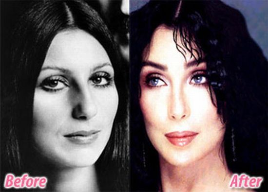 stars_plastic_surgery_09