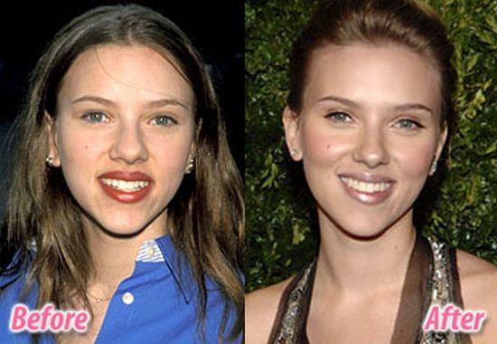 stars_plastic_surgery_12