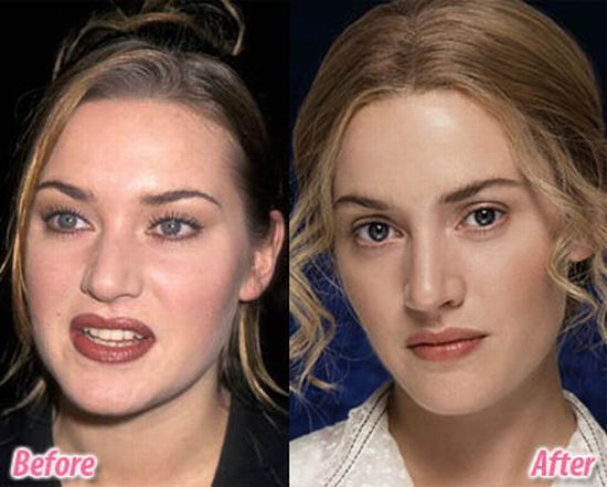 stars_plastic_surgery_13