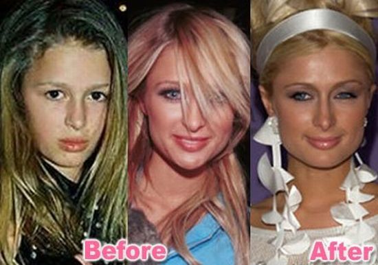 stars_plastic_surgery_32